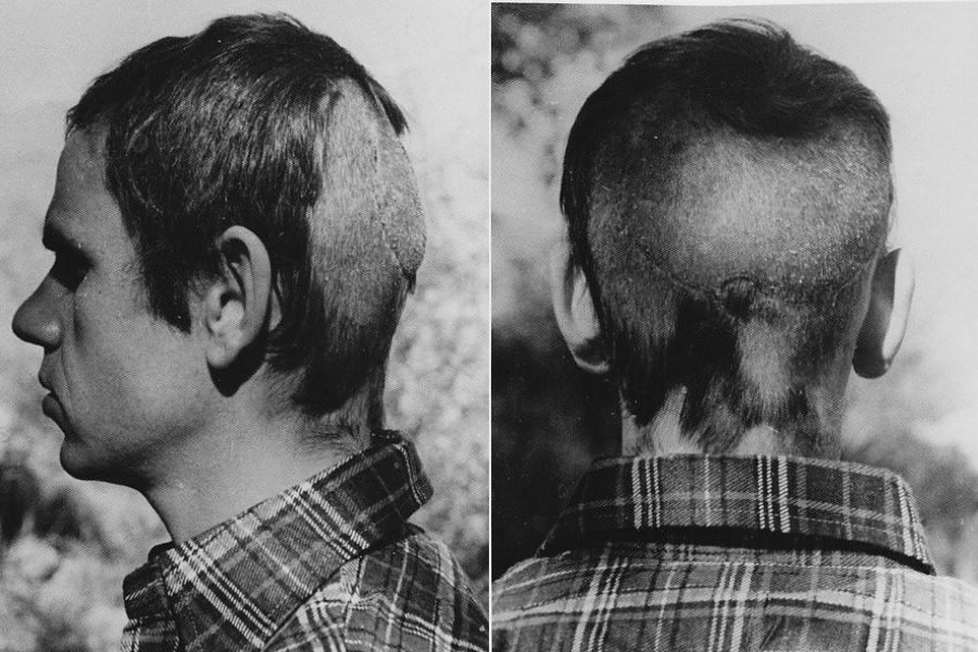 Black-and-white side-by-side images showing a man’s head from the side and back, revealing a large, healed wound with visible scarring and significant hair loss, likely from a traumatic injury or surgery; he wears a plaid shirt in both photos.